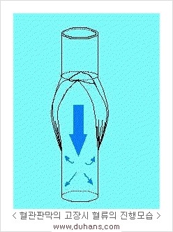 [두한성형외과 경쟁력 정맥류 치료] - [정맥류의 원인과 문제점, 정맥류 진단 방법] 관련 이미지 4