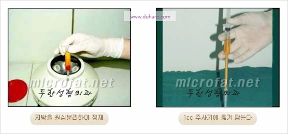[두한성형외과 경쟁력 눈밑성형] - [눈밑애교살 필러 시술의 부작용 교정 방법] 관련 이미지 7