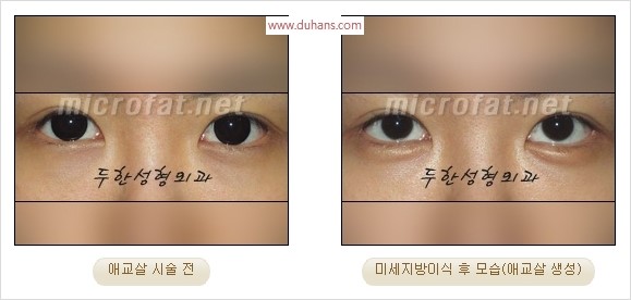 ​﻿[두한성형외과 경쟁력 지방이식] - [눈밑 애교살 시술을 위한 미세지방이식] 관련 이미지 39