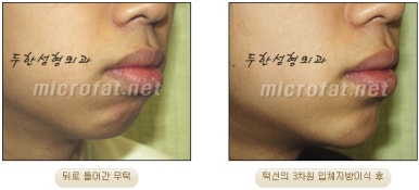 [Duhan Plastic Surgery Clinic Microgenia Correction] - [Chin Microfat Grafting] image 20