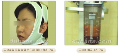 [두한성형외과 안전한 지방흡입] - [얼굴지방흡입] 관련 이미지 9