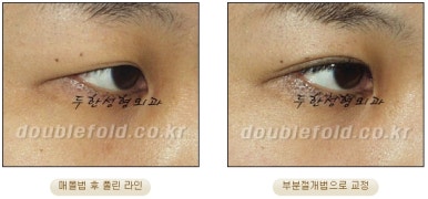Best Place for Double Eyelid Revision Surgery, Duhan Plastic Surgery - Partial Incision Eye Revision Surgery image 36