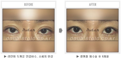 두한성형외과 쌍커풀 재수술 - 짝눈 눈매교정, 가성 안검하수 교정과 뒤밑트임 관련 이미지 36