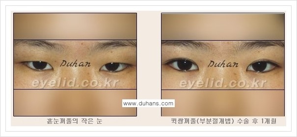 [두한성형외과 경쟁력 쌍꺼풀 재수술, 극한 재수술] - [쌍꺼풀 수술 관련 질문과 답변] 관련 이미지 4