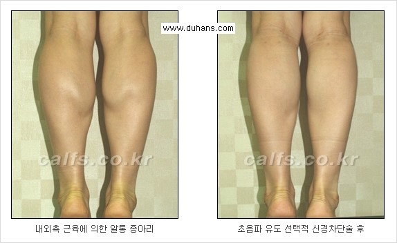 [두한성형외과 경쟁력 멀티종아리성형] - [종아리 근육 퇴축술에 관한 질문과 답변] 관련 이미지 21