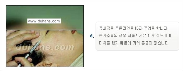 [두한성형외과 젊어지는 주름교정술] - [주름제거 시술방법 ④] 관련 이미지 9