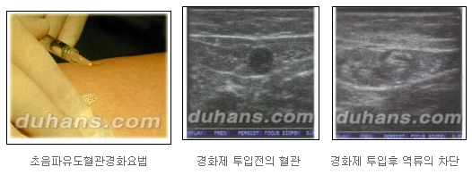 [두한성형외과 정맥류] - [정맥류 시술안내] 관련 이미지 10