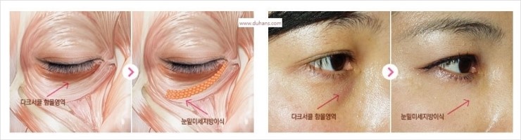 [두한성형외과 경쟁력 눈밑성형] - [눈밑 다크써클 맞춤 치료 방법] 관련 이미지 1