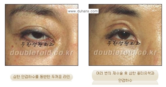 [두한성형외과 신두한 원장 눈성형 관련 컬럼] - [극한 눈재수술] 관련 이미지 2