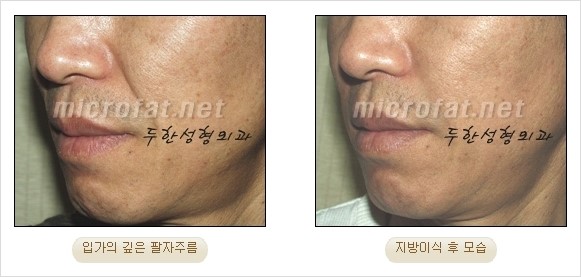 [두한성형외과 경쟁력 안티에이징 동안성형] - [주름이 깊은 푹~ 꺼진 입가 팔자주름 안녕!] 관련 이미지 16