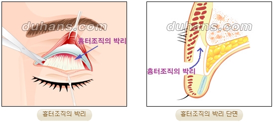 눈성형잘하는곳 두한성형외과 - 겹쌍꺼풀 관련 이미지 17