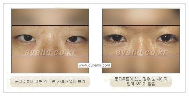[두한성형외과 경쟁력 맞춤 눈성형] - [눈성형에 관한 자주하는 질문과 답변 안내] 관련 이미지 16