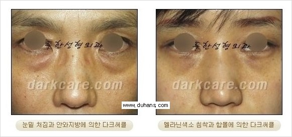 [두한성형외과 경쟁력 눈밑성형] - [젊은 눈매 하안검 성형술(눈밑주름 제거술)] 관련 이미지 4