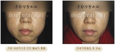 [두한성형외과 지방이식] - [지방이식 부작용 종류와 문제점] 관련 이미지 28
