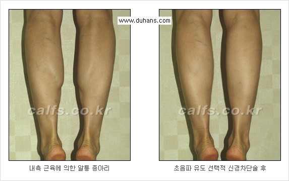 [두한성형외과 경쟁력 멀티종아리성형] - [종아리 근육 퇴축술에 관한 질문과 답변] 관련 이미지 23