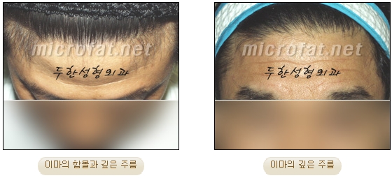 이마성형 두한성형외과 - 이마주름, 이마지방이식 관련 이미지 2