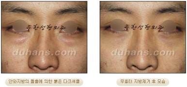 [두한성형외과 지방제거] - [눈두덩이지방제거, 눈밑지방제거] 관련 이미지 41