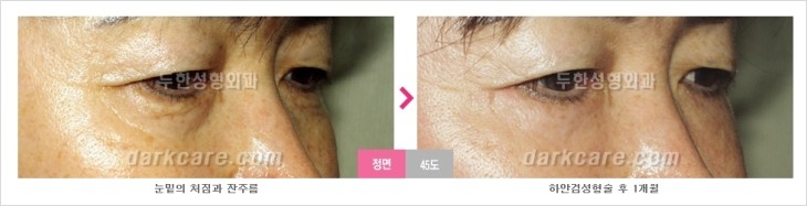 두한성형외과 눈밑수술 - 다크서클 수술 전후 관리 안내 관련 이미지 89