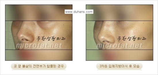 [두한성형외과 경쟁력 귀족성형] - [3차원 입체 미세지방이식 귀족수술 + 인디언밴드 교정] 관련 이미지 15