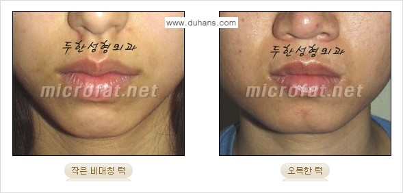 [두한성형외과의 경쟁력 미세지방이식] - [무턱교정 - 턱 미세지방이식 안내 1.] 관련 이미지 2