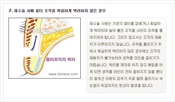 ​​[두한성형외과 경쟁력 쌍꺼풀(눈) 재수술] - [쌍꺼풀(눈) 재수술 실패의 원인 분석 안내] 관련 이미지 4