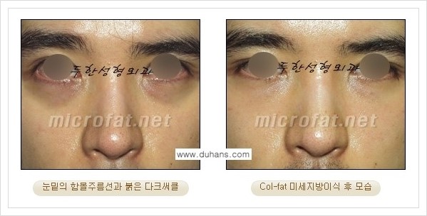 [두한성형외과 경쟁력 눈밑성형] - [눈밑 다크써클과 눈밑 함몰주름의 최적화 교정방법 안내] 관련 이미지 8