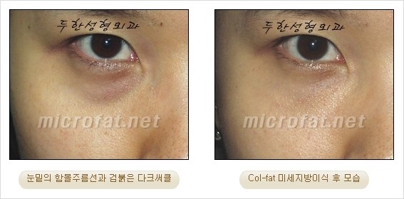 ​[두한성형외과 경쟁력 눈밑성형 리더] - [눈밑 다크써클의 증상, 원인, 종류, 치료방법 안내] 관련 이미지 26