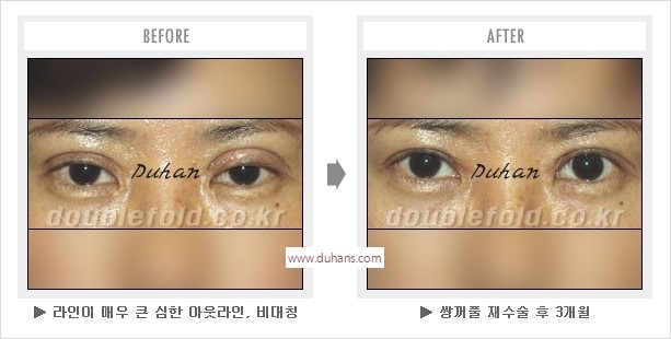 [두한성형외과 경쟁력 눈성형] - [나에게 맞는 어울리는 쌍꺼풀 라인] 관련 이미지 35