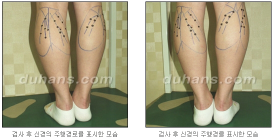 [두한성형외과 종아리 퇴축] - [종아리 퇴축술 재발 재수술] 관련 이미지 6