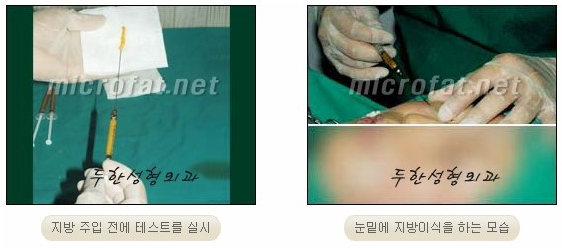 ​[두한성형외과 지방이식] - [애교살] 관련 이미지 5