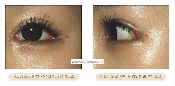 [두한성형외과 NO.1 눈성형] - [뒤트임 수술에 대한 정보] 관련 이미지 6