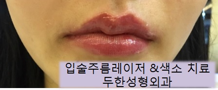 [Duhan Plastic Surgery Wrinkle Improvement] - [Wrinkle Lifting] image 63