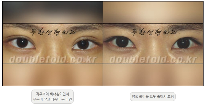 [두한성형외과 쌍커플재수술] - [비대칭 쌍커풀 라인] 관련 이미지 13