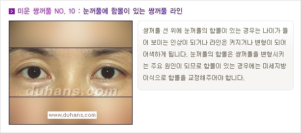 [두한성형외과 경쟁력 쌍꺼풀 재수술, 극한 눈재수술] - [자연스러운 눈매로의 복원 쌍꺼풀 재수술 대상 안내] 관련 이미지 11