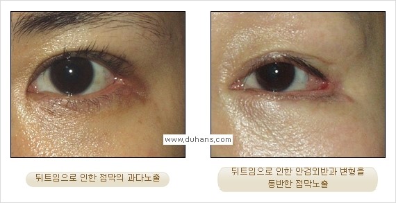[두한성형외과 경쟁력 쌍꺼풀 재수술, 극한 눈재수술] - [뒤트임 수술의 부작용 안내] 관련 이미지 2