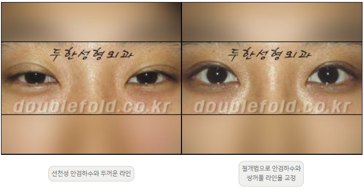 [Ptosis, Duhan Plastic Surgery] - [Sleepy-Looking Eyes, Ptosis Eye Correction] image 13