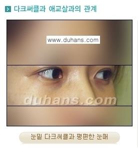 [두한성형외과 경쟁력 미세지방이식] - [눈밑 애교살을 위한 미세지방이식 2.] 관련 이미지 3