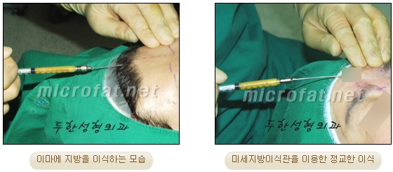 이마성형 두한성형외과 - 이마주름, 이마지방이식 관련 이미지 8