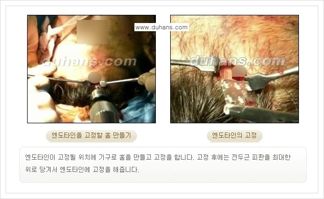 [두한성형외과 경쟁력 주름성형] - [엔도타인 리프팅 안내 ②] 관련 이미지 13