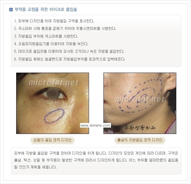 [두한성형외과 경쟁력 지방이식] - [지방이식 부작용 교정 안내 2.] 관련 이미지 1