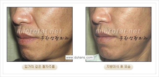 [두한성형외과 경쟁력 지방이식] - [입가주름, 팔자주름 미세지방이식의 안내] 관련 이미지 10