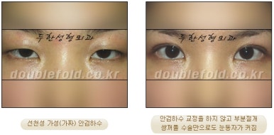 [두한성형외과 눈성형] - [안검하수 재수술] 관련 이미지 6