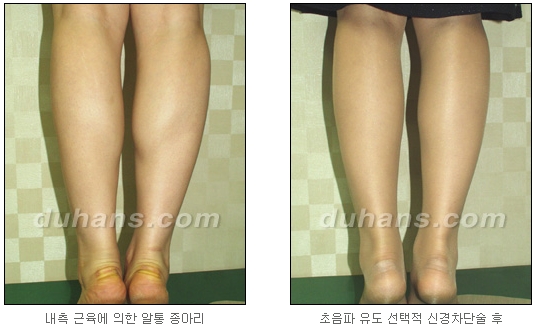 [Duhan Plastic Surgery Calf Reduction] - [How to Get Rid of Calf Muscle Bulges] image 20
