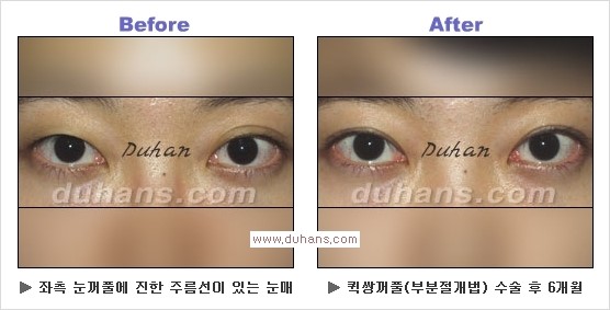 ​[두한성형외과 경쟁력 눈성형] - [자연스러운면서 매력적인 쌍꺼풀 퀵 쌍꺼풀 수술 안내] 관련 이미지 19