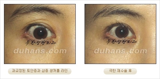 [두한성형외과 경쟁력 쌍꺼풀 재수술 리더 ] - [쌍꺼풀 재수술 과정, 쌍꺼풀 재수술 실패의 원인, 극한 재수술] 관련 이미지 15