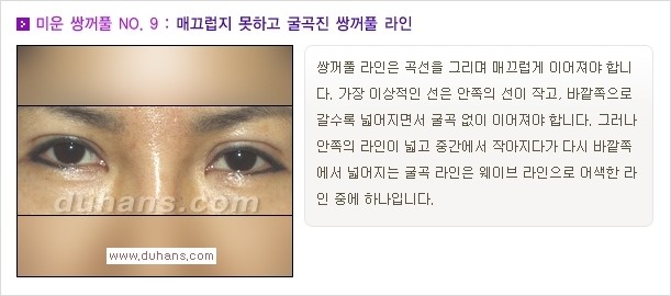 [두한성형외과 경쟁력 쌍꺼풀 재수술, 극한 눈재수술] - [자연스러운 눈매로의 복원 쌍꺼풀 재수술 대상 안내] 관련 이미지 10