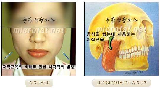 [두한성형외과 보톡스] - [사각턱 보톡스 시술 안내] 관련 이미지 2