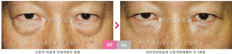 [두한성형외과 눈밑수술] - [눈밑지방재배치의 적응증] 관련 이미지 21