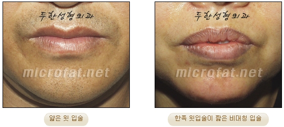 [Duhan Plastic Surgery Lip Surgery] - [Lip Correction Fat Grafting] image 2