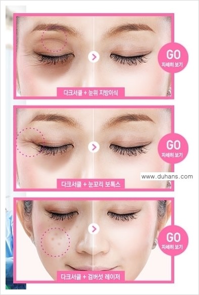 [두한성형외과 경쟁력 다크써클 치료] - [다크써클 5단계로 이뤄지는 핵심 5 STEP SOLUTION 안내 2.] 관련 이미지 6